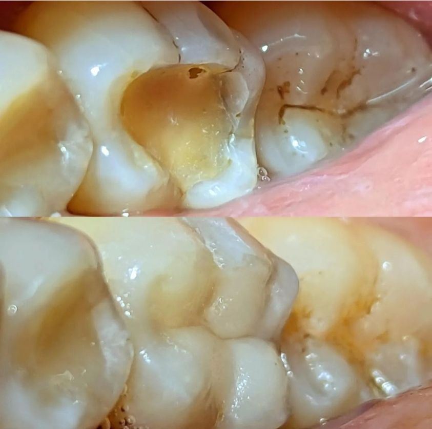 Eduardo replaced an old worn down filling for a patient with a new one that he shade matched and built up respecting the anatomy of the tooth.